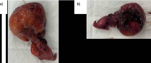 Intraoperative specimen (a) anterior view and (b) posterior view of resected Meckle’s diverticulum.