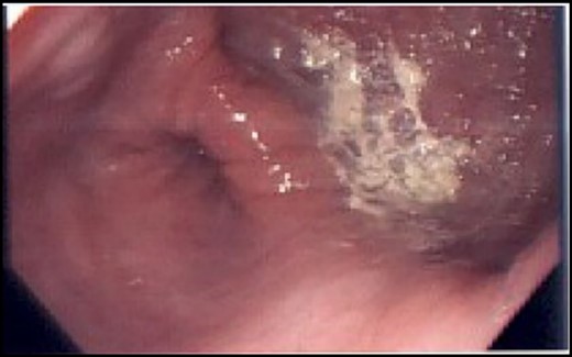 Large epiphrenic ED visualized on upper endoscopy.