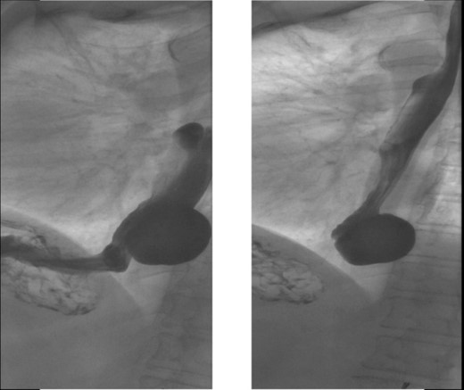 X-ray esophagram fluoroscopy showing a 6.0 × 5.0 cm epiphrenic ED with a 3.3 cm neck.