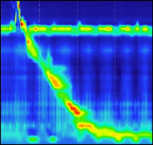 Normal motility pattern on high-resolution manometry test in a patient with epiphrenic ED.