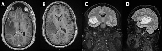 Mass lesion occupying the HG on the right temporal gyrus on (A) axial post-contrast T1 - (B) axial non-contrast T1- (C + D) T1-weighted sagittal and coronal FLAIR MRIs, respectively.