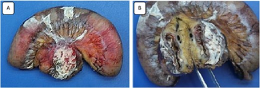 Images of the surgical specimen showing the monobloc resection of the proximal jejunum and the perforated mesenteric cystic lymphangioma.
