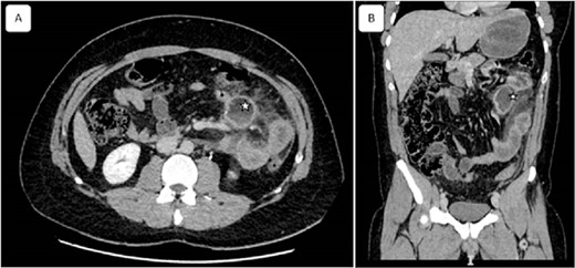 Coronal and sagittal views of computed tomography showing a mesenteric collection of 51 × 33 with mesenteric fat infiltration (asterisk) related to the peritonitis caused by the ruptured cyst. Reconstructed images: (A) axial and (B) sagittal view.