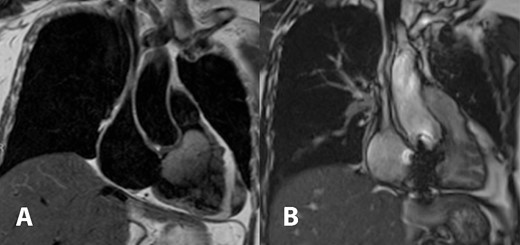 Cardiac magnetic resonance imaging demonstrated T2 hyperintense partially mobile 60 × 39 × 46 mm mass occupying the right ventricular cavity and causing outflow tract obstruction (A). Comparison to post-surgical resection in picture (B) showed decreased right atrial and ventricular size, the tricuspid bioprosthetic valve in place, and right ventricular function returned to normal.