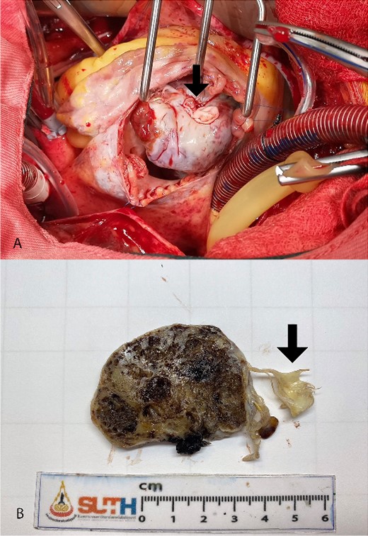 Intra-operative finding shows lobulated mass protruding from right atriotomy involving the anterior leaflet of the tricuspid valve (A). The gross pathological cut surface shows a polypoid mass with spongy appearance and focal fibrosis (B). Arrows are indicated anterior leaflet of the tricuspid valve.
