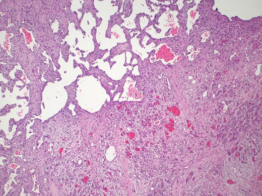 Mixed cavernous-capillary hemangioma. The histologic examination reveals dilated thin-walled blood vessels (left upper) admixed with capillary-sized blood vessels (right lower) on fibrotic stroma (hematoxylin and eosin, 40x).