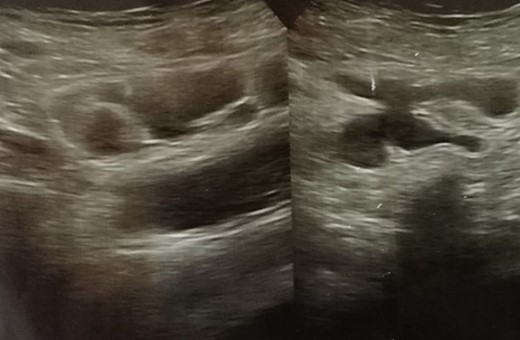 Ultrasonography showing dilated small bowel loops (ileum).