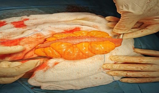 Intraoperative view of multiloculated cystic lesion found in the mesentery at the distal part of the ileum.