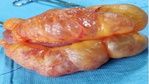 Surgical specimen of lymphangiomas.