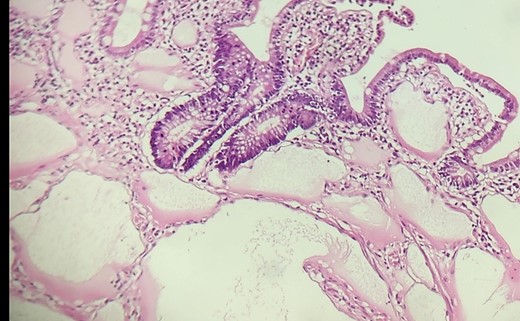 Histological results showed that small bowel mucosa and submucosa with multiple small dilated vascular spaces lined by endothelial lining.