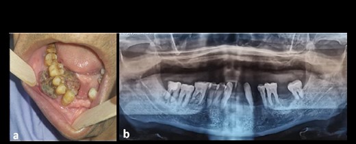 (a) Clinical image of an intraoral EA localized at the mandibular gingiva with extensive red-purple appearance; (b) orthopantomographic image showing resorption of the mandibular bone around the crown of the 44 and 46 teeth.