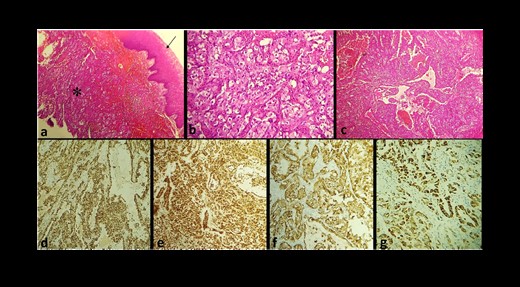 (a) Microphotography of EA showing a solid and sheet-like proliferation (star) under the squamous epithelium covering the gingival mucosa (arrow) (Hematoxylin–Eosin ×10); tumor cells show marked cellular pleomorphism with abundant eosinophilic cytoplasm (Hematoxylin–Eosin ×10); (c) the tumor exhibits a vasoformative architecture; at IHC, tumor cells express CD31 (d), ERG (e), CKAE1/AE3 (f), and CK7 (g).