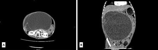 (A) Axial low-dose CT scan shows a huge cystic mass with few enhanced thin septa in the lateral aspect. Cystic space contains fluid of density 47−60HU. (B) Sagittal low-dose CT scan revealed that the cystic mass had expansive features with its cranial aspect not differentiated from the lower liver surface. No certain CT signs of liver infiltration were seen.