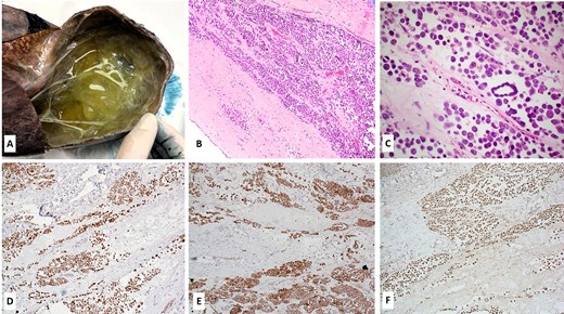 Gross, microscopic and immunohistochemical findings of the tumor. (A) Grossly, a multilocular cystic mass was seen, with cysts filled with yellowish-to-green fluid; (B–C) Microscopic features of the tumor (Hematoxylin and Eosin stain, 10X magnification image B and 20X magnification image C); the tumor cells were diffusely positive for calretinin (D), D2.40 (podoplanin) (E) and retained BAP1 protein expression (F) (immunohistochemistry, DAB staining).