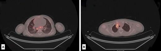 Low-dose PET/CT scan from the level of upper thoracic aperture revealing enlarged and metabolically active retrocaval and mediastinal lymph nodes, with SUVmax 8.6 and SUVmax up to 6.5 (A). Also, at the level of the carina and subcarinal region metabolically active lymph nodes were seen (SUVmax up to 7.6). In the right hilus, metabolically active lymph node SUVmax up to 3.5 was also observed (B).