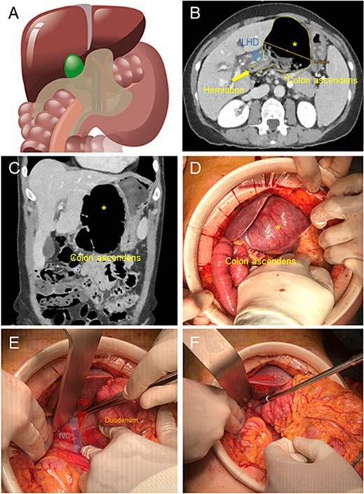 (A) Illustration of cecal herniation through WF as shown in CT scan. (B) Dilated colon ascendens behind the Ligamentum Hepatoduodenale (LHD) in the CT Scan. (C) The coronary view shows the dilated colon. (D) Intraoperative hernia presentation after laparotomy, the dilated colon presents a serosal tear (*) in its surface. (E) After reduction of hernia, exposure of WF, with inferior vena cava below and Duodenum to the right. (F) Closure of WF with interrupted suture with p-Dioxanon (PDS 4-0).
