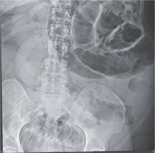 X-ray showing multiple dilated small bowel loops.