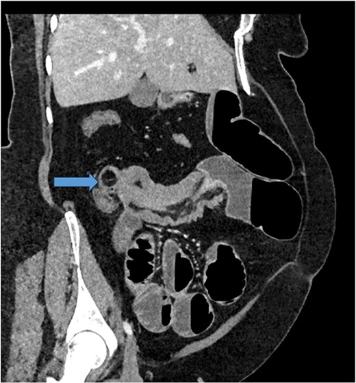 CT scan of abdomen: oblique coronal view of abdomen showing intussusception with low attenuation lesion distally C/W a lipoma (arrow).