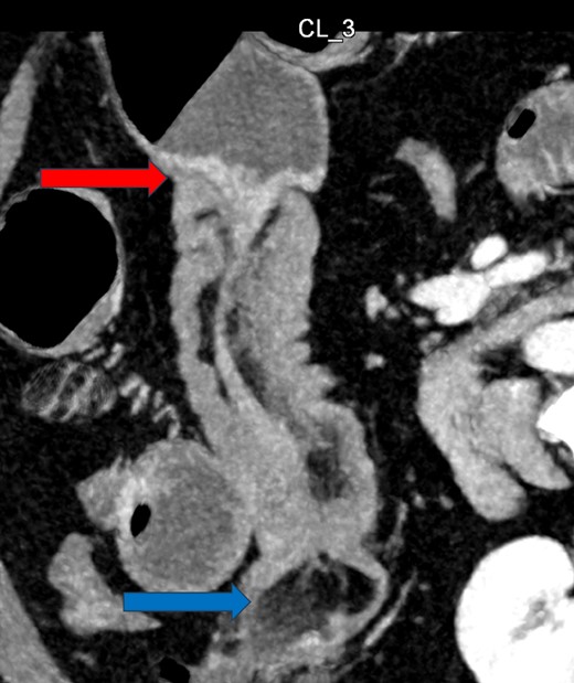 CT Abdomen: MPR reconstruction of the plane of intussusception showing a distal lipoma and proximal start of intussusception.