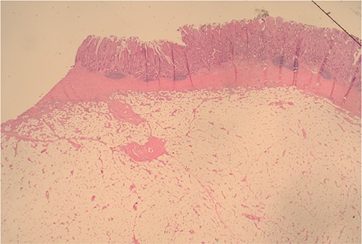 12.5× magnification showing the intact surface small bowel mucosa with the underlying lipoma.