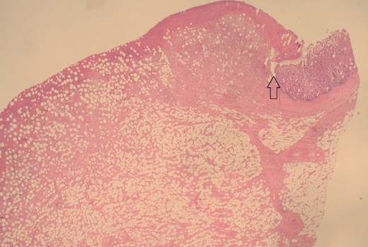 12.5× magnification showing the junction between the ulcerated leading point of the intussusception on the left and the preserved mucosa on the right of the arrow.