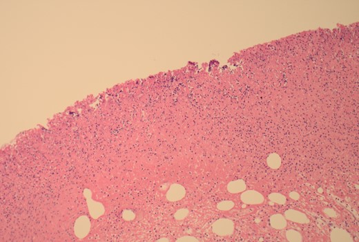 100× magnification showing the ulcerated surface of the lipoma which is covered by fibrin and neutrophils. The clear cystic spaces below this are the residual fat cells.