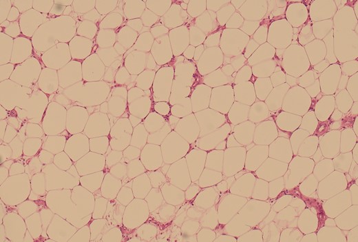100× magnification of the lipoma illustrating the adipocytes which show cytoplasmic distention by optically clear fat.