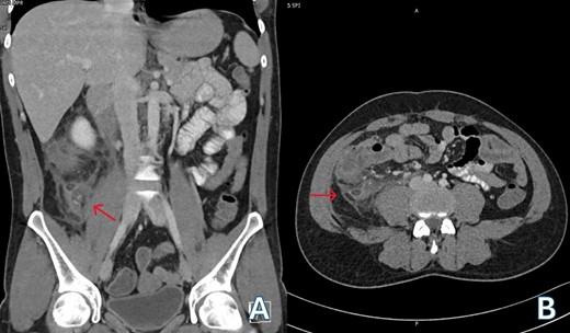 (A) Venous phase computed tomography (CT) of abdomen showing dilated appendix with peri appendicular fat stranding and inflammation (red arrow); (B) Axial computed tomography (CT) of abdomen showing retrocecal appendix with severe inflammation involving up to the retroperitoneal musculature (red arrow).
