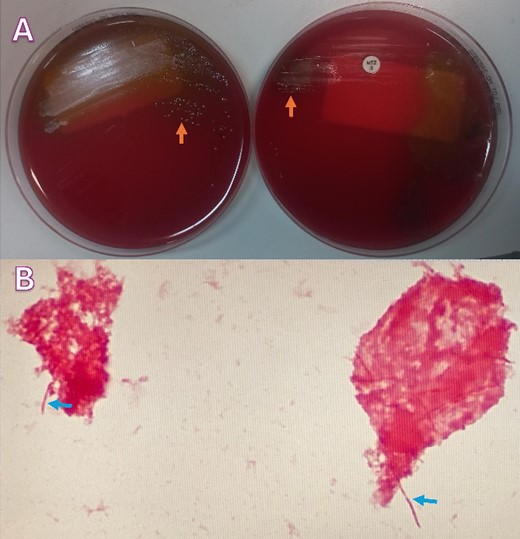 (A) Blood agar plates under anaerobic conditions growing moist and gray-white colonies (orange arrows); (B) Gram-stain analysis showing Gram-negative rods (blue arrows).