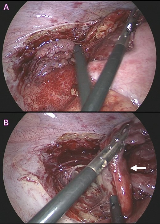 Surgical images during laparoscopic appendectomy showing; (A) acutely inflamed retrocecal appendix buried retroperitoneally; (B) retroperitoneal large abscess pocket with ruptured appendix with thick pus and inflammatory exudates (white arrow).
