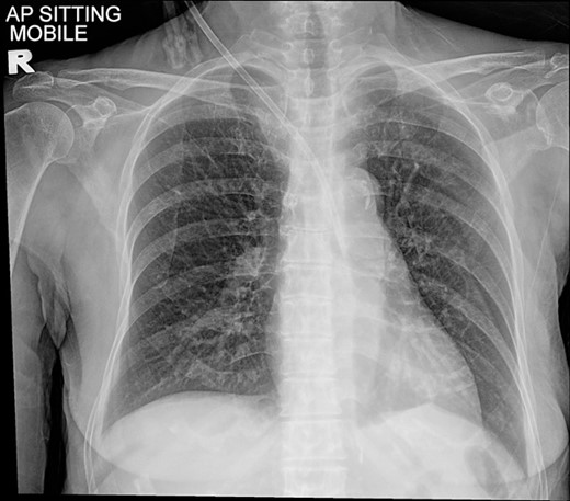Chest radiograph showing a malpositioned central vein catheter.
