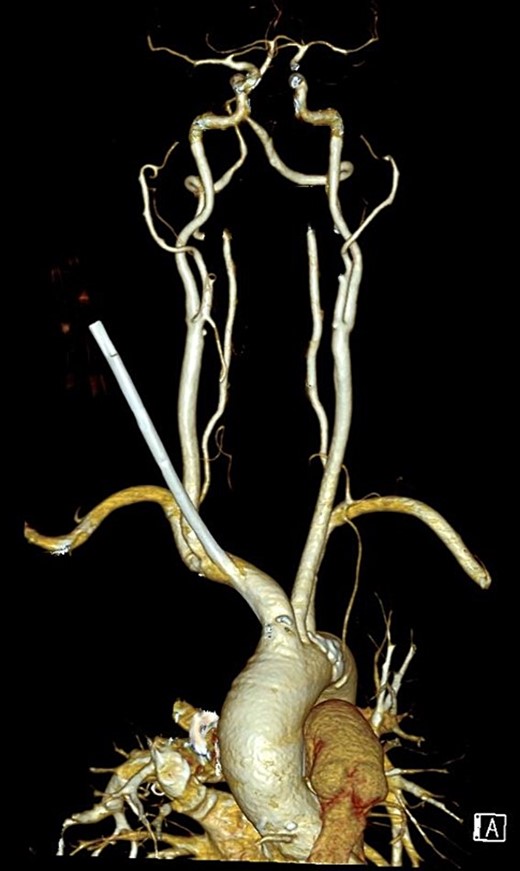 3-dimensional reconstruction of a CT angiogram of the neck and thorax depicting the ectopic haemodialysis catheter in the brachiocephalic artery.