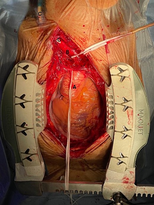 Intraoperative findings: A: Ascending aorta, B: Brachiocephalic artery, C: Malpositioned haemodialysis catheter in the brachiocephalic artery.