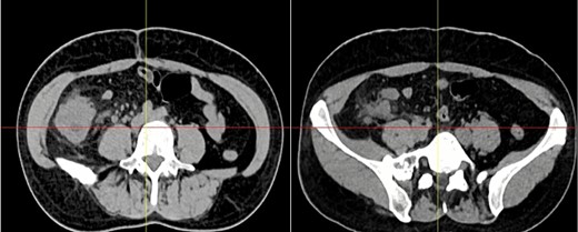 Abdominal CT, the mass is seen in the cecum and ileocecal valve.
