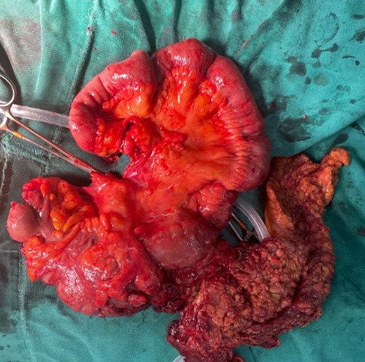 The mass is completely removed from the patient; it involves the cecum and ileocecal valve.