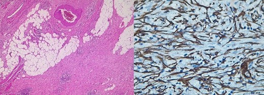 Immunohistochemistry: positive for actin and ALK.