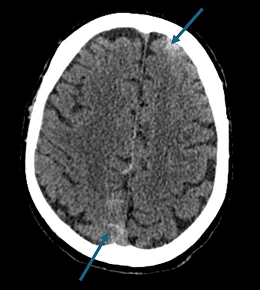Non-contrast axial head computed tomography scan demonstrating biconvexity subarachnoid hemorrhage.