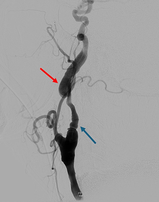 Digital subtraction angiography showing left internal carotid artery dissection (arrow on the left) with pseudoaneurysm formation (arrow on the right).