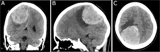 Preoperative CT imaging; (A) coronal, (B) sagittal, and (C) axial CT scans show a large right parietooccipital lesion with vasogenic oedema, mass effect, and midline shift.