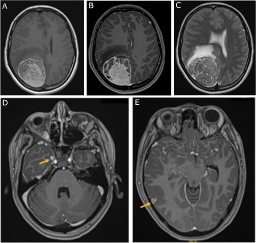 Preoperative MRI; (A) pre-contrast, (B) post-contrast T1-weighted, and (C) T2-weighted axial MRI scans show a large right parietooccipital extra-axial mass with diffusely increased T1 signal without corresponding enhancement; (D, E) axial post-contrast T1-weighted MRI scans show two discrete lobular lesions along the medial aspect of the right temporal lobe and posterior cortical surface of the temporal lobe respectfully.