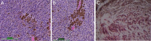 Tumor histopathology and immunohistochemical analysis; (A, B) hematoxylin and eosin-stained sections of heavily pigmented cellular neoplasm with spindled to oval tumor cells with limited cytologic atypia and mitotic count under 0.5 mitoses/mm2; (C) immunohistochemistry was positive for Melan A; red color represents MelanA immunopositivity; magnification: 3A: 100×, 3B and 3C: 200×.