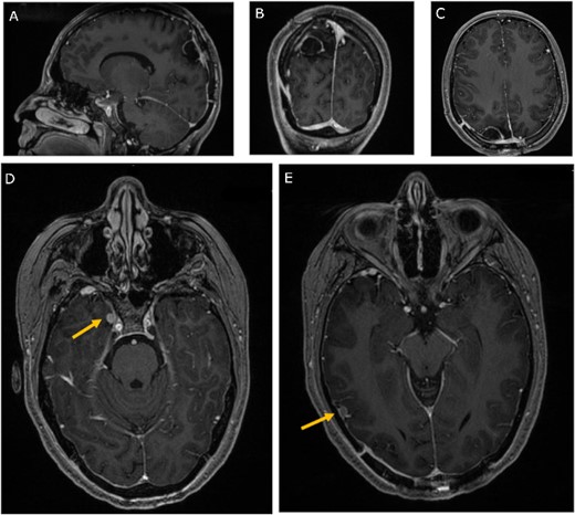 Three-month follow-up MRI; (A) sagittal, (B) coronal, and (C) axial post-contrast T1-weighted MRI scans show peripheral contrast enhancement at the parietal resection margin with areas of nodularity related to postoperative changes without recurrence; (D, E) axial post-contrast T1-weighted MRI shows stability of the medial and lateral temporal lobe lesions.