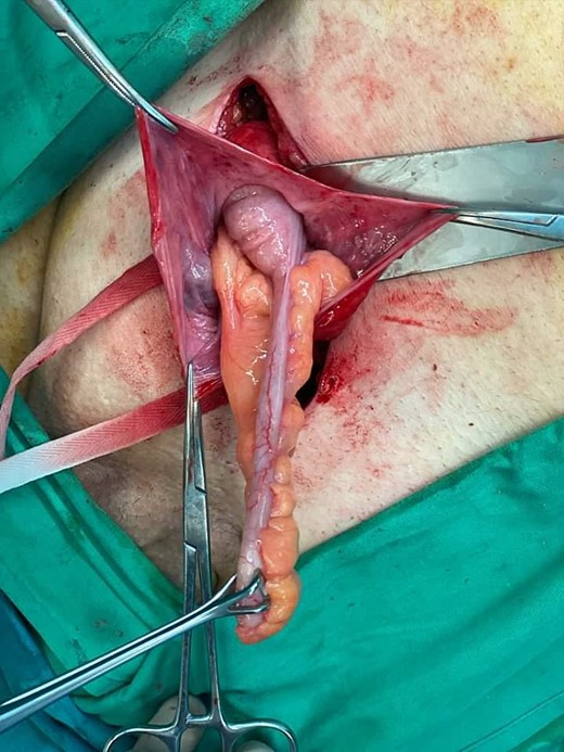 Amyand’s hernia—open approach. The hernia sac was opened and it was found to contain the appendix.