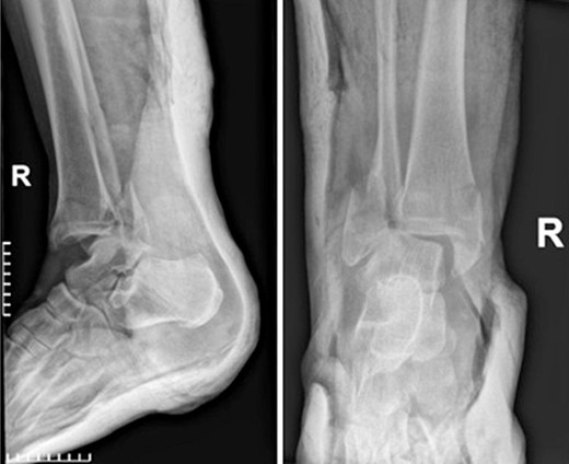 Anteroposterior and lateral X-ray of the ankle joint showing the trimalleolar fracture.