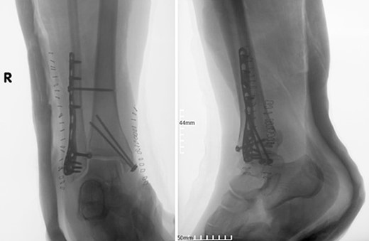 Postoperative anteroposterior and lateral X-ray of the ankle joint after ORIF of the fracture.