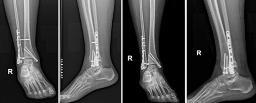 Anteroposterior and lateral X-ray of the ankle joint showing the broken syndesmotic screw and the replacement with a 3.5-mm cortical screw on the lateral malleolus 8 weeks after the initial surgery.