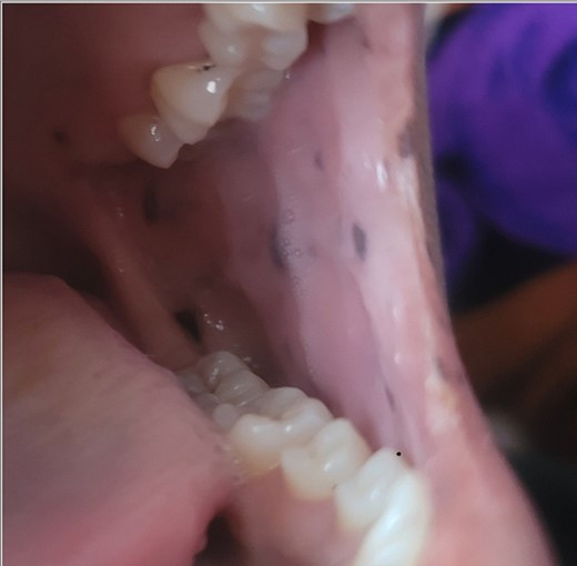 Mucocutaneous pigmentation on the buccal mucosa and lips.