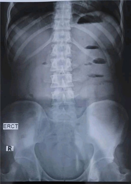 Abdominal X-rays in erect position reveals five air fluid levels.