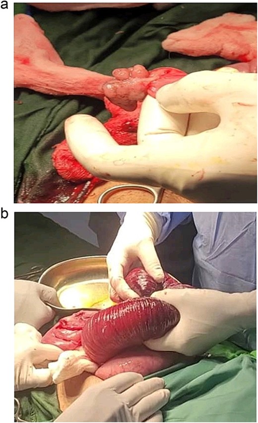 View during the surgery: intussusception jejuno-jejunal and hamartomatous polyps of the ileum.