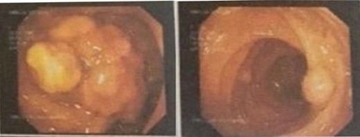 Colonoscopy with multiple polyps.